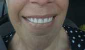 Horrible over priced dentures