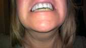 Tetracycline Stained Teeth