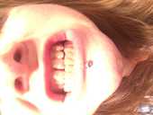 Yellow/blacking dark teeth, gum disease, fibromyalgia
