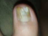 MY TOE NAIL IS DESTROYED