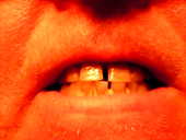 Tetracycline staining of the teeth